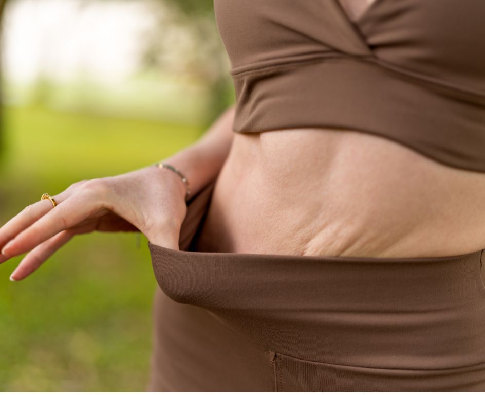 Excess skin after weight loss