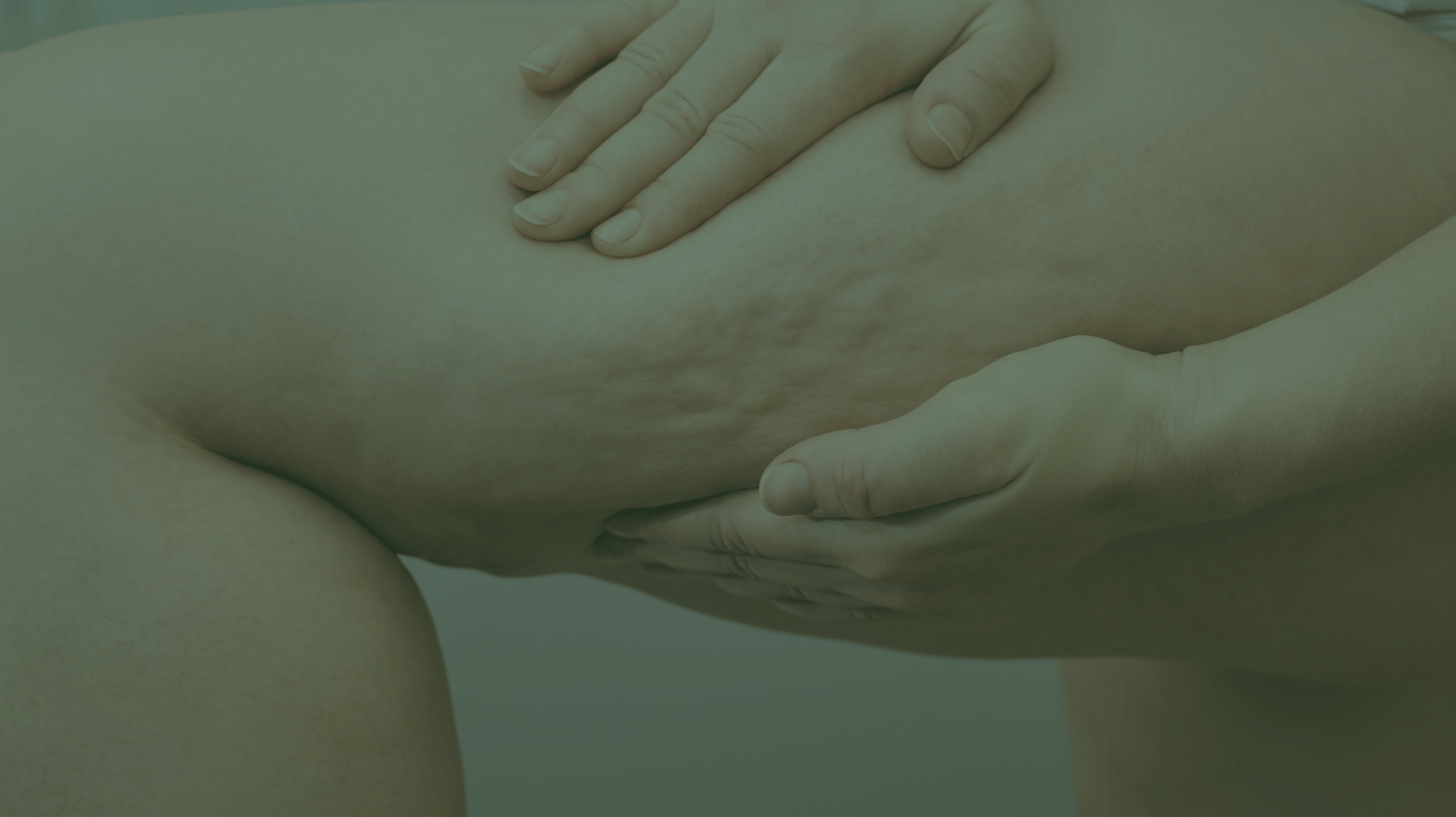 Cellulite – where does it come from?