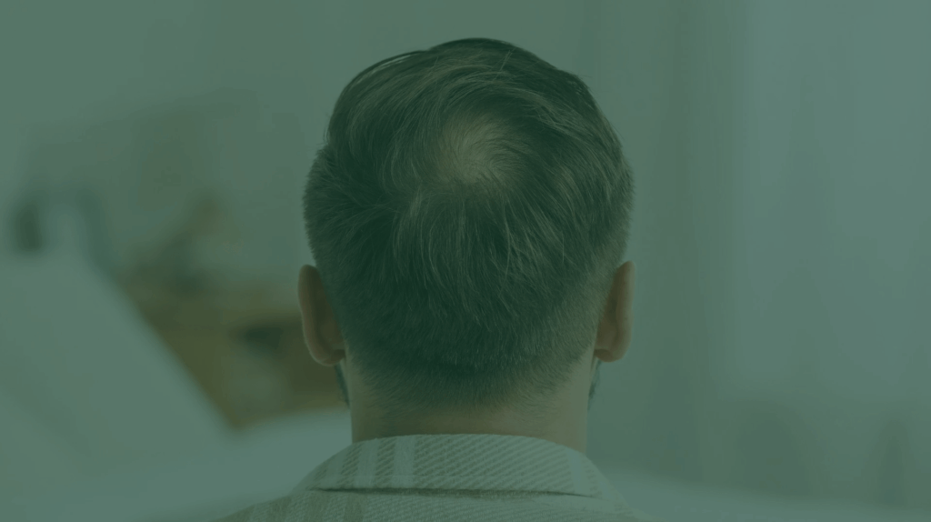 androgenetisk alopecia