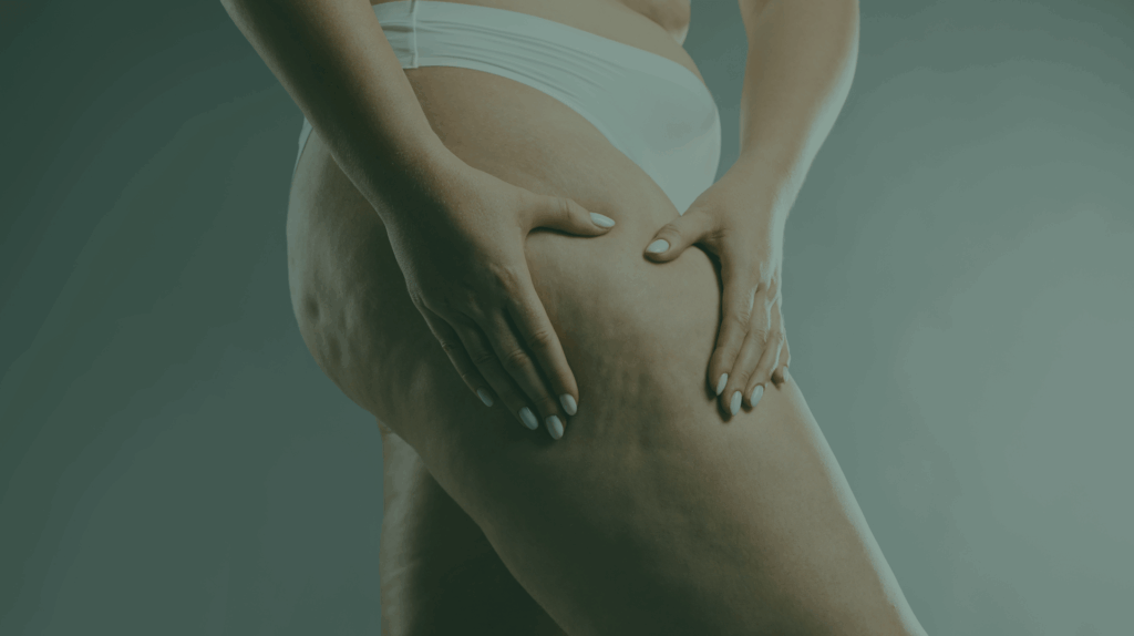 cellulite on the skin
