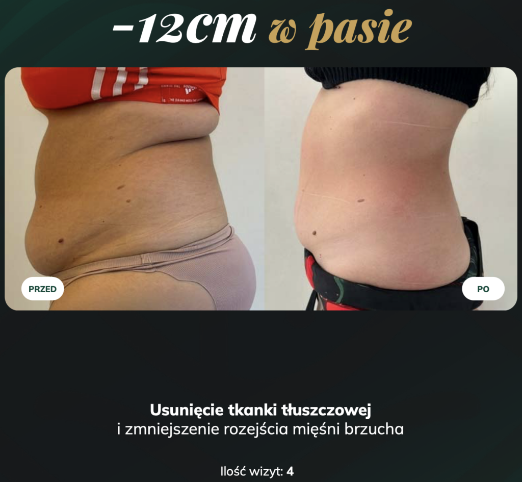 Metamorfoza przed i po. Zmiana obwodu pasa o 12 cm po 4 wizytach.
