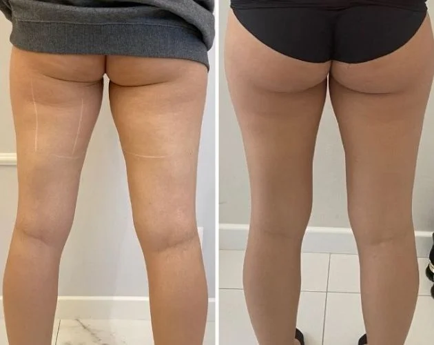Alternative zum brasilianischen Po-Lifting – Vorher und Nachher