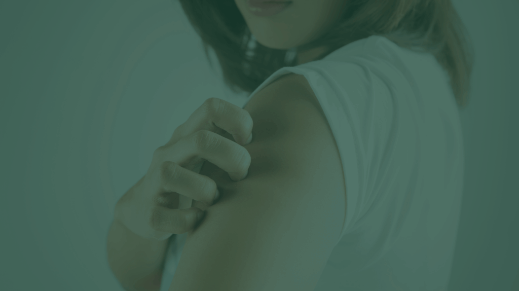 urticaria
