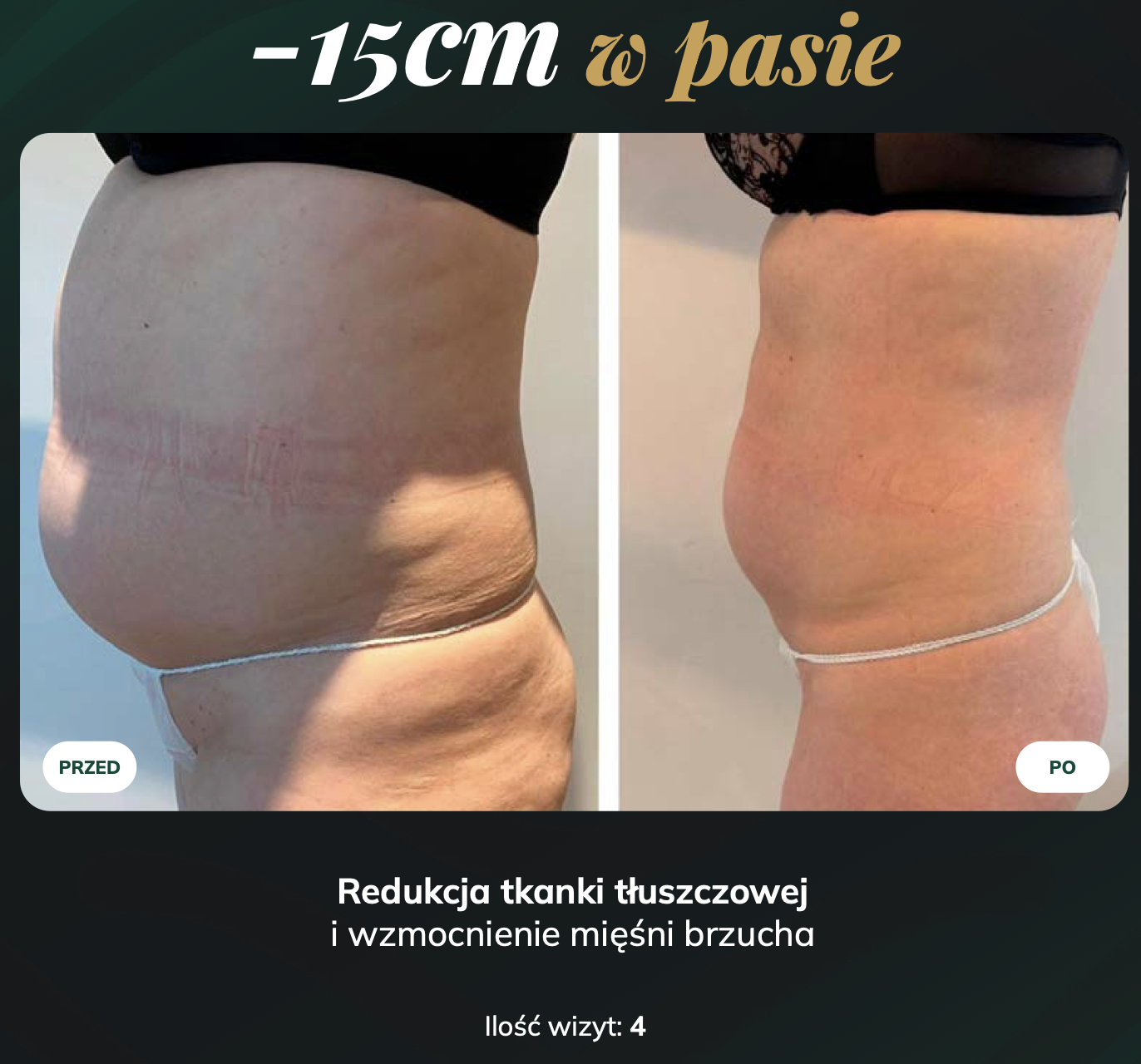 Before and after photos of the figure. The graphic shows a 15 cm reduction in waist circumference after 4 sessions.
